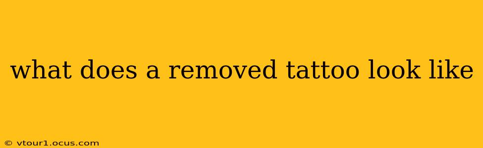 what does a removed tattoo look like