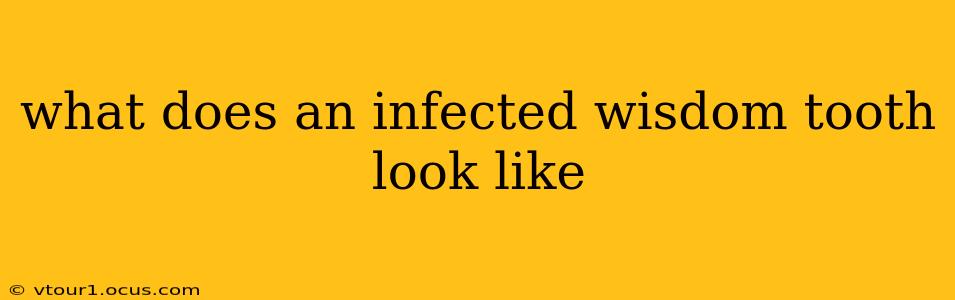 what does an infected wisdom tooth look like