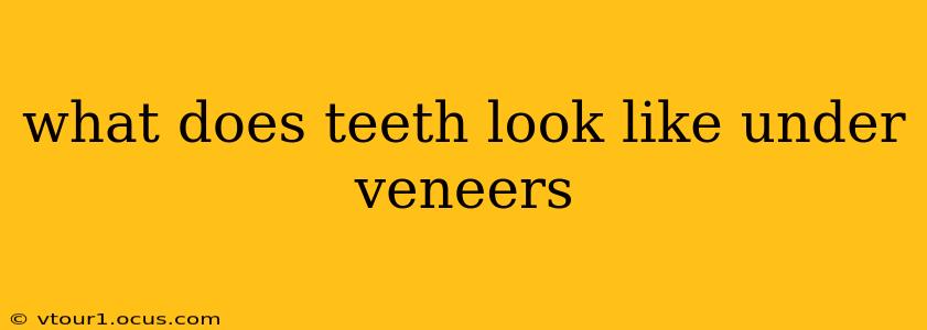 what does teeth look like under veneers
