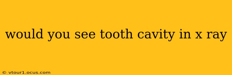 would you see tooth cavity in x ray